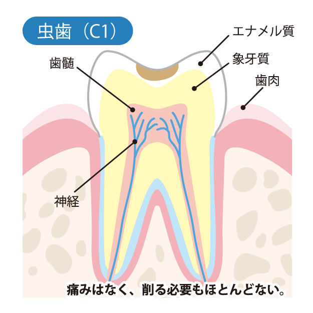 北名古屋市の歯医者でむし歯治療