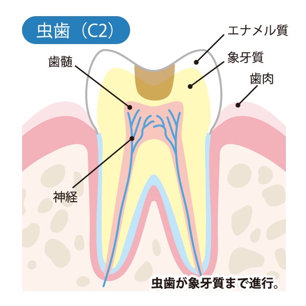 北名古屋市の歯医者でむし歯治療