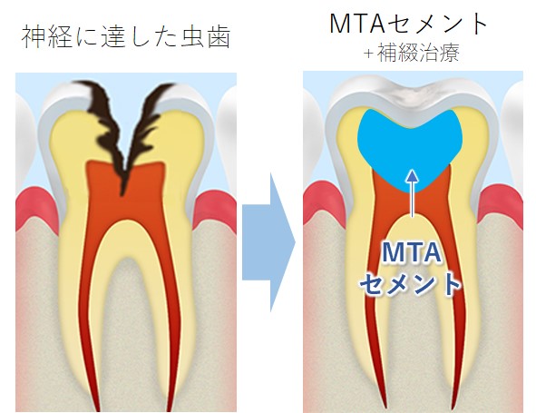 北名古屋市の歯医者の根管治療