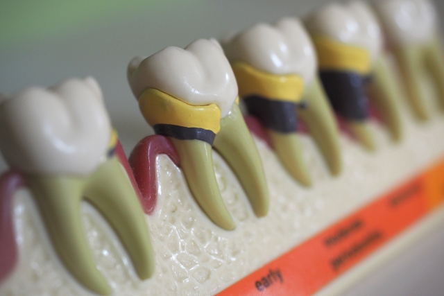 北名古屋の歯医者の歯周病治療