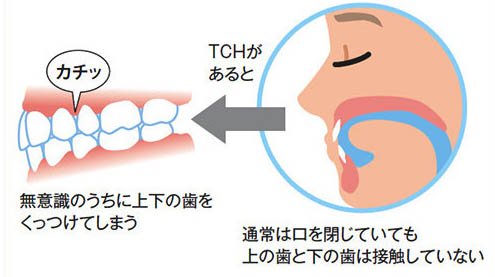 北名古屋市の歯医者で歯ぎしり・食いしばり対策